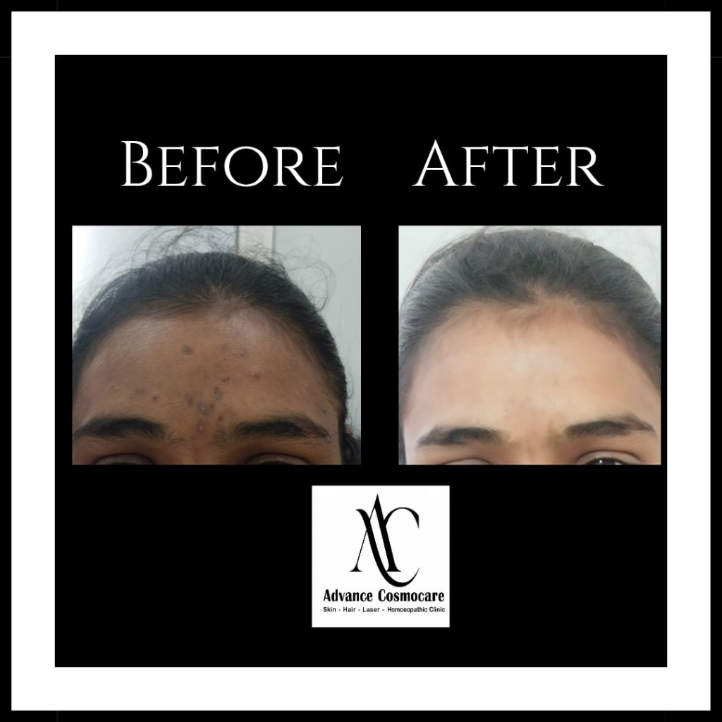 Acne Before and After Clinical Result showing skin clearance and texture improvement