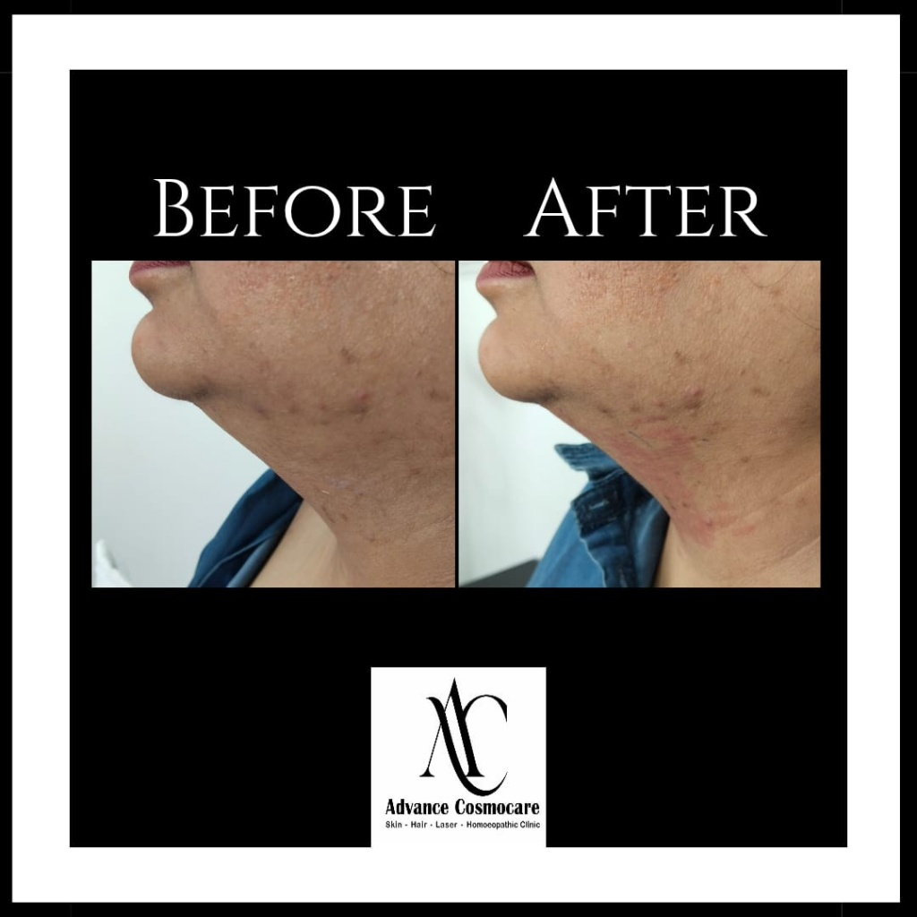 HIFU Skin Tightening Before and After Clinical Result showing jawline definition and double chin reduction