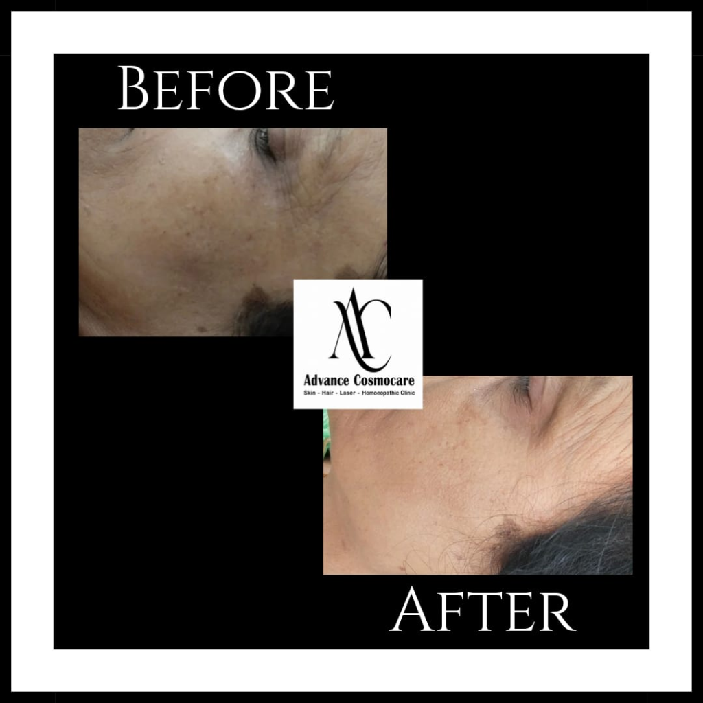 HydraFacial Before and After Clinical Result showing skin texture and radiance improvement