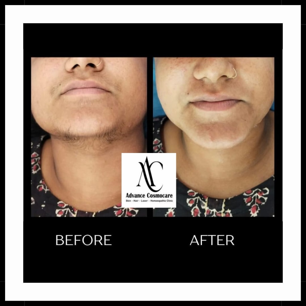 Laser Hair Reduction Before and After Clinical Result